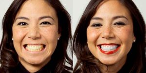 Professional Teeth Whitening for Safe and Effective Results